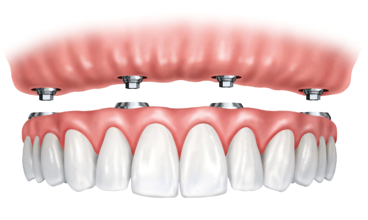 Mini" Implants for Denture Retention